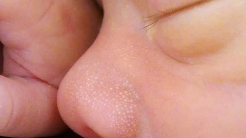 Mụn kê thường xuất hiện ở cánh mũi với hình dáng các đốm trắng